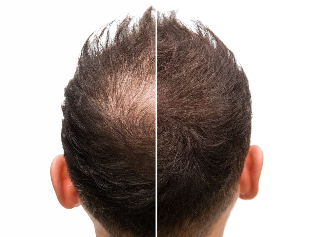 عکس سر یک آقا که نشان دهنده‌ی قبل و بعد از درمان ریزش مو است