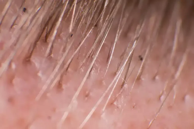 نمای نزدیک از واحدهای فولیکولی قابل مشاهده آماده کاشت مو دائمی