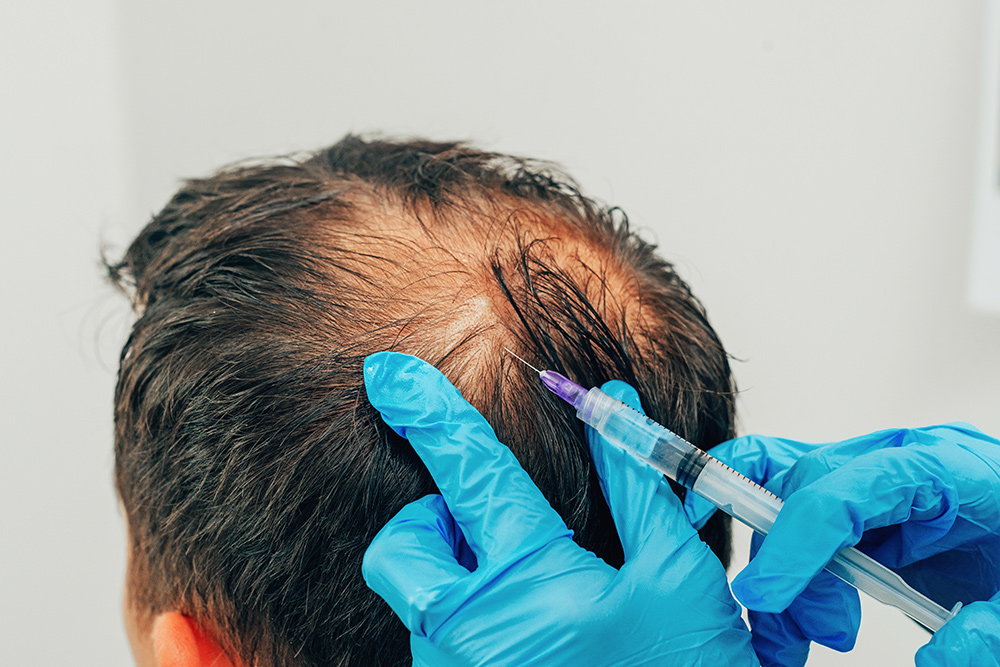 درمان ریزش مو با پلاسمای غنی از پلاکت (PRP) |بهترین درمان ریزش مو | هیر پارادایس تهران
