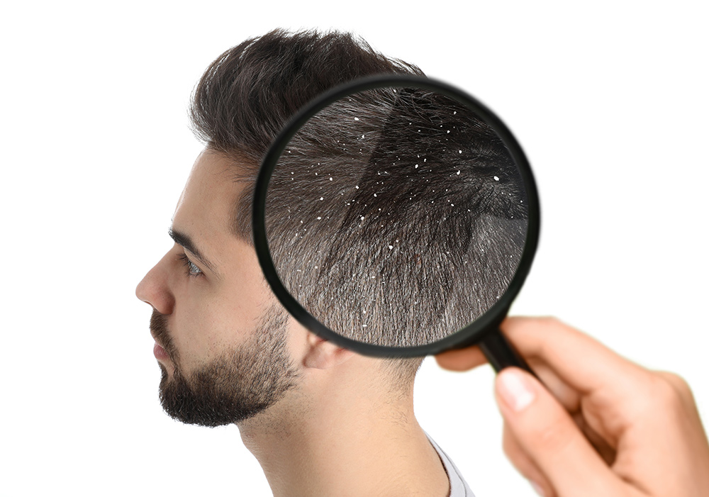 چگونه میتوان شوره سر و ریزش مو را درمان کرد